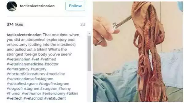 Shocking! See the photo of a bikini that doctor removed from someone’s intestine